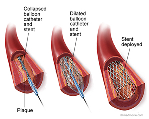 A graphic view of angioplasty